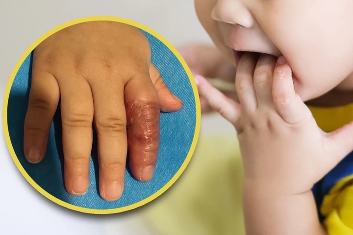 Mẹ dùng băng quấn để ngăn con mút tay, em bé suýt phải cắt cụt ngón- Ảnh 1.