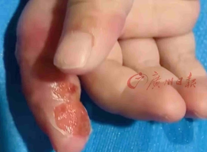 Mẹ dùng băng quấn để ngăn con mút tay, em bé suýt phải cắt cụt ngón- Ảnh 2.