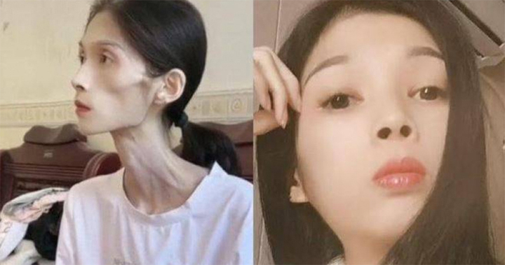 Số phận bi thảm của cô gái xinh đẹp biến thành 'bộ xương di động' 17kg- Ảnh 1.