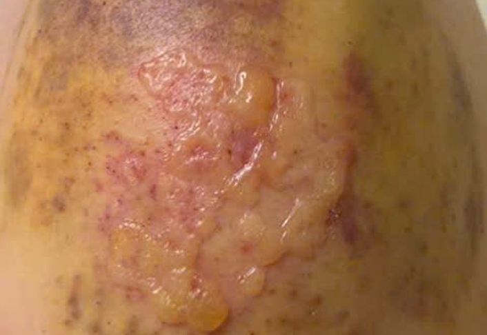 Liều lĩnh đánh cược mạng sống với mẹo 'chích máu trị gout'- Ảnh 1.