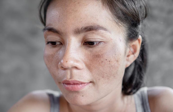 Loại lá trong vườn có tác dụng trị nám, làm sáng da nhanh chóng: Mùa hè có thể dùng để uống hoặc đắp mặt nạ- Ảnh 1.