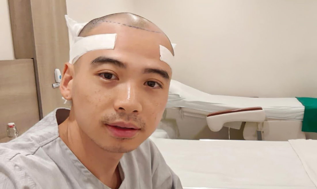 Chồng H'Hen Niê thay đổi thế nào sau cấy tóc trị hói đầu? Phương pháp này có giá bao nhiêu?- Ảnh 3.
