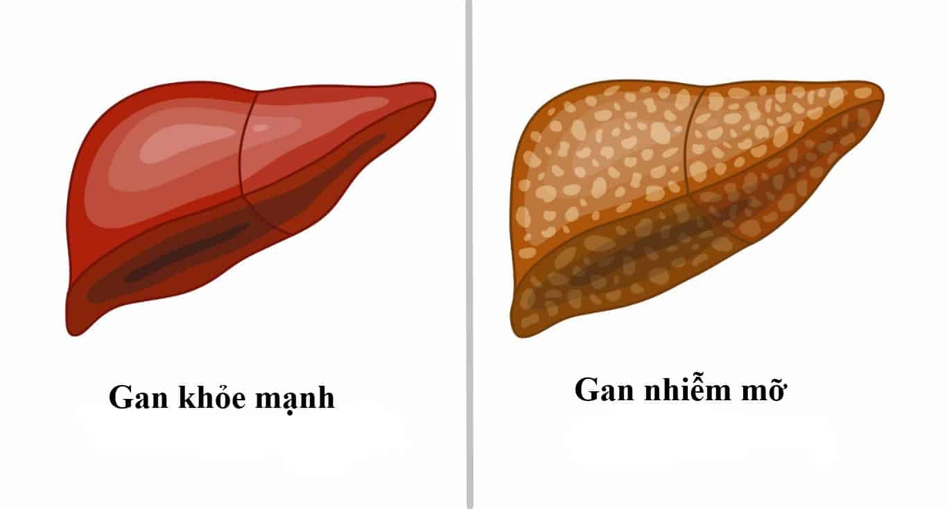 Bé trai 9 tuổi đã bị xơ gan, bác sĩ khuyến cáo thay đổi 1 điều trong ăn uống nhưng cha mẹ  bỏ qua khiến bệnh càng nặng- Ảnh 4.