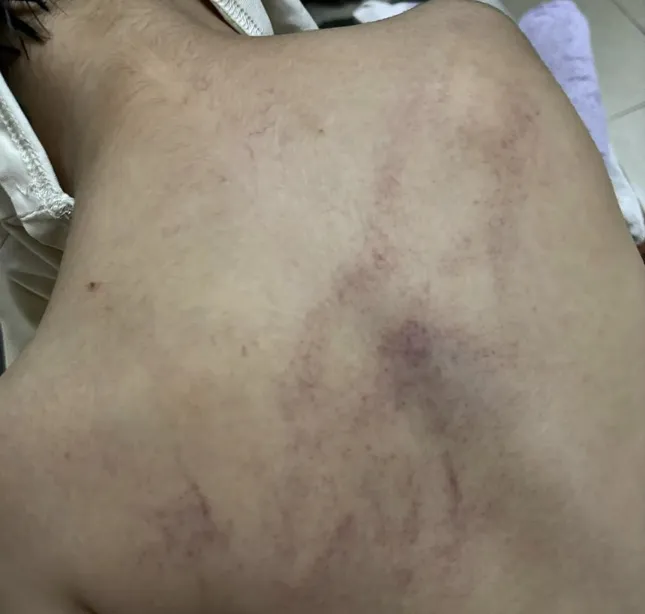 Bé mẫu giáo bị đánh tím lưng, clip từ camera khiến phụ huynh bàng hoàng- Ảnh 1.