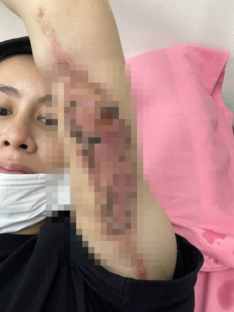 Netizen Việt sốc vì người phụ nữ có tay biến dạng sau hút mỡ, sự thật là gì?- Ảnh 4.