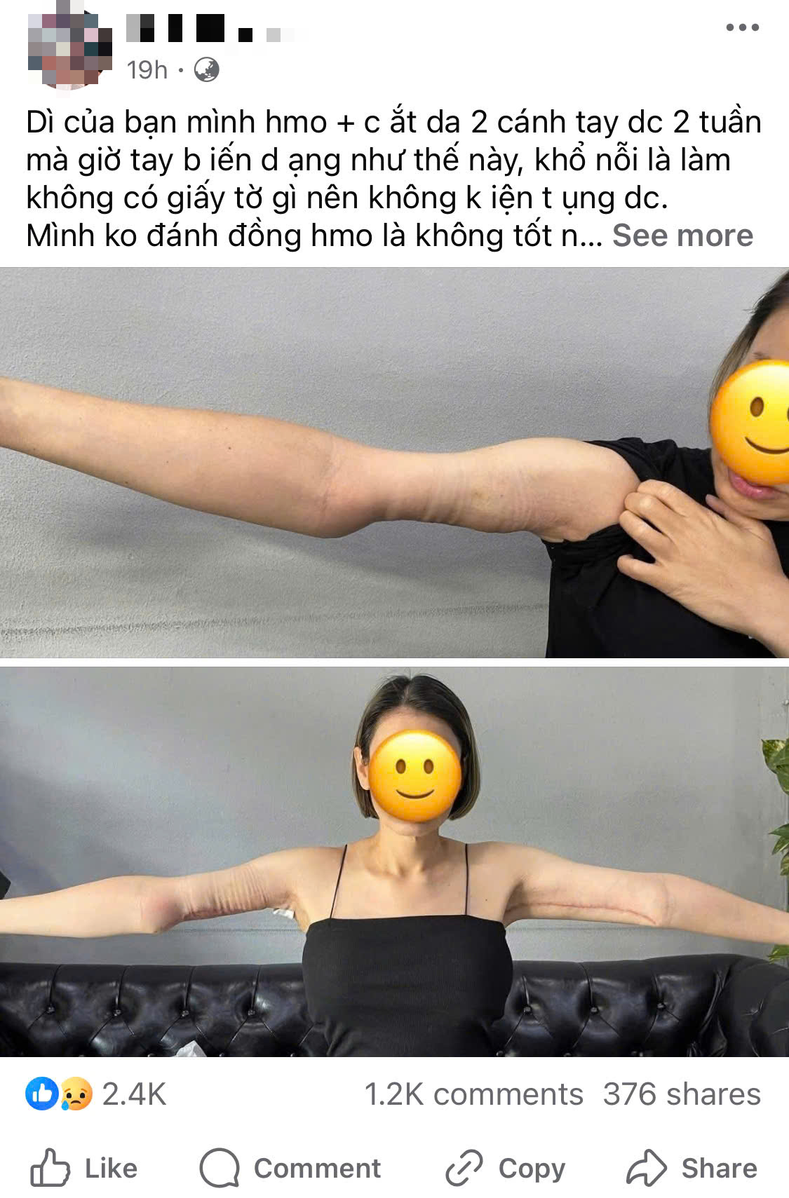 Netizen Việt sốc vì người phụ nữ có tay biến dạng sau hút mỡ, sự thật là gì?- Ảnh 1.