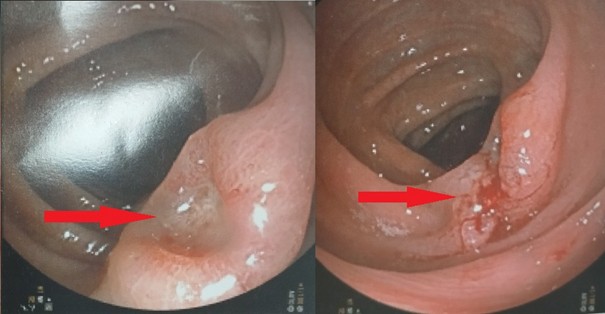Phát hiện mắc 2 loại ung thư cùng lúc khi đi khám ho: Bác sĩ Bạch Mai nhắn nhủ 2 điều quan trọng- Ảnh 2.