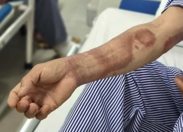 Ba năm mang 'chấm lạ', hai cha con đi khám mới biết mắc bệnh phong- Ảnh 1.