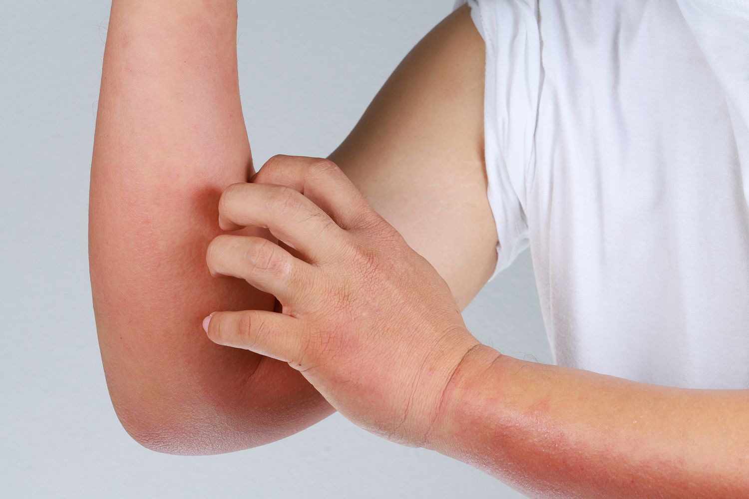 5 dấu hiệu trên da cảnh báo gan đang suy hỏng giai đoạn đầu: Có 1 cũng đừng bỏ qua!- Ảnh 4.