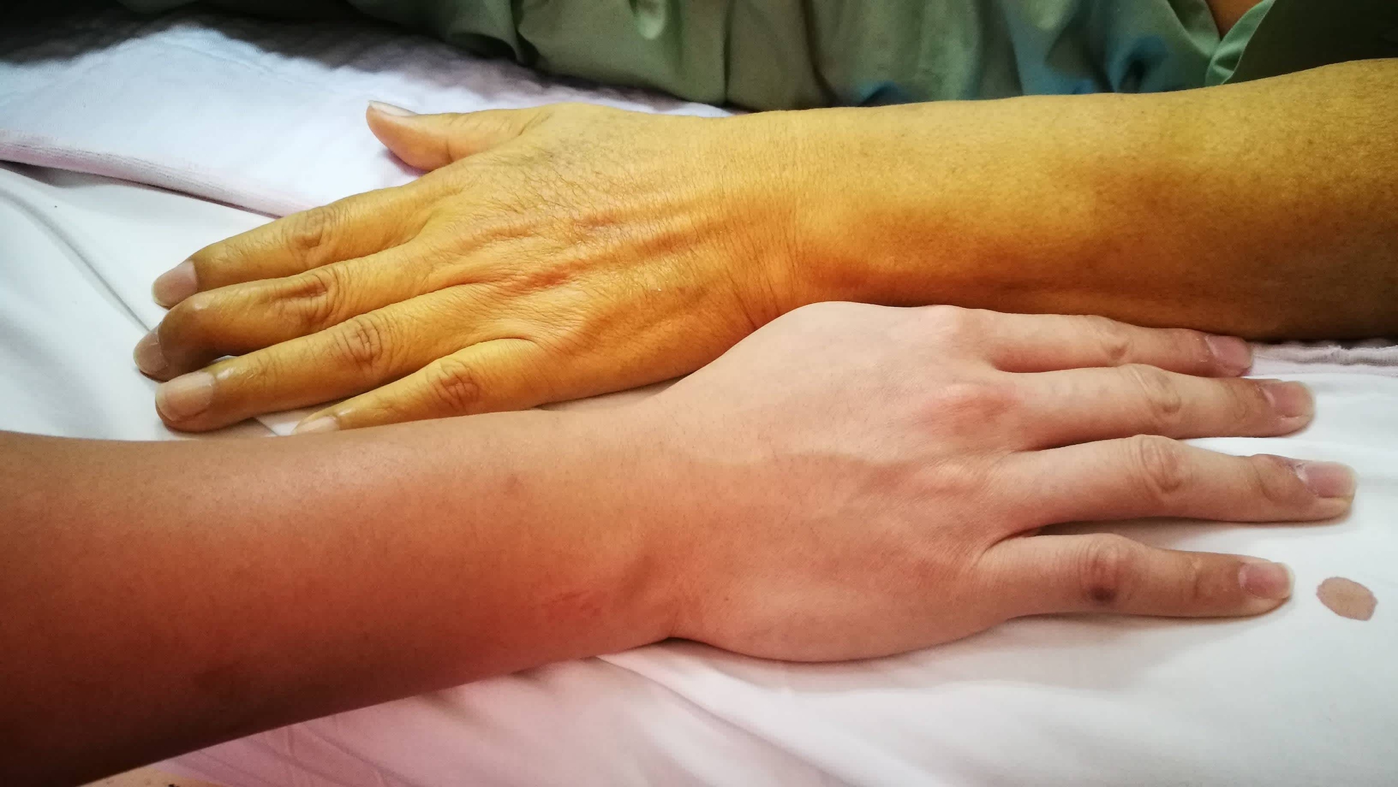 5 dấu hiệu trên da cảnh báo gan đang suy hỏng giai đoạn đầu: Có 1 cũng đừng bỏ qua!- Ảnh 1.