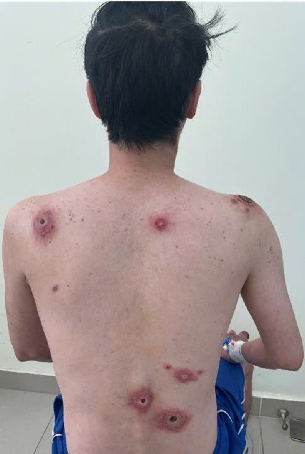 Nam nhân viên văn phòng lở loét toàn thân vì quan hệ tình dục bừa bãi- Ảnh 1.
