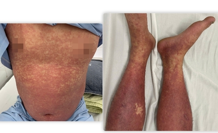 Tử vong sau khi uống thuốc chống viêm Phenylbutazone đã bị cấm lưu hành- Ảnh 1.