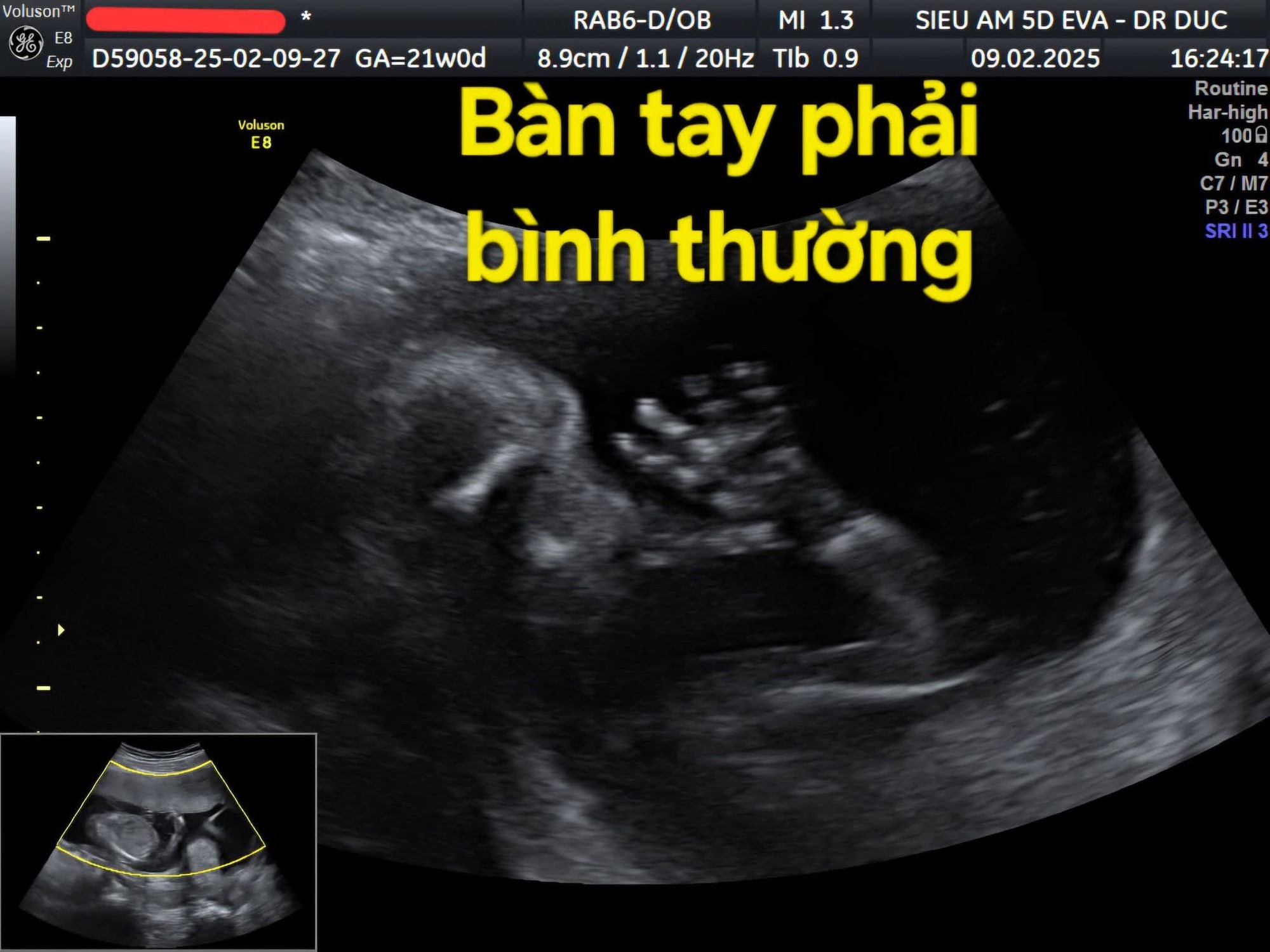 Thai nhi 21 tuần bị cắt cụt các ngón tay vì một thứ 