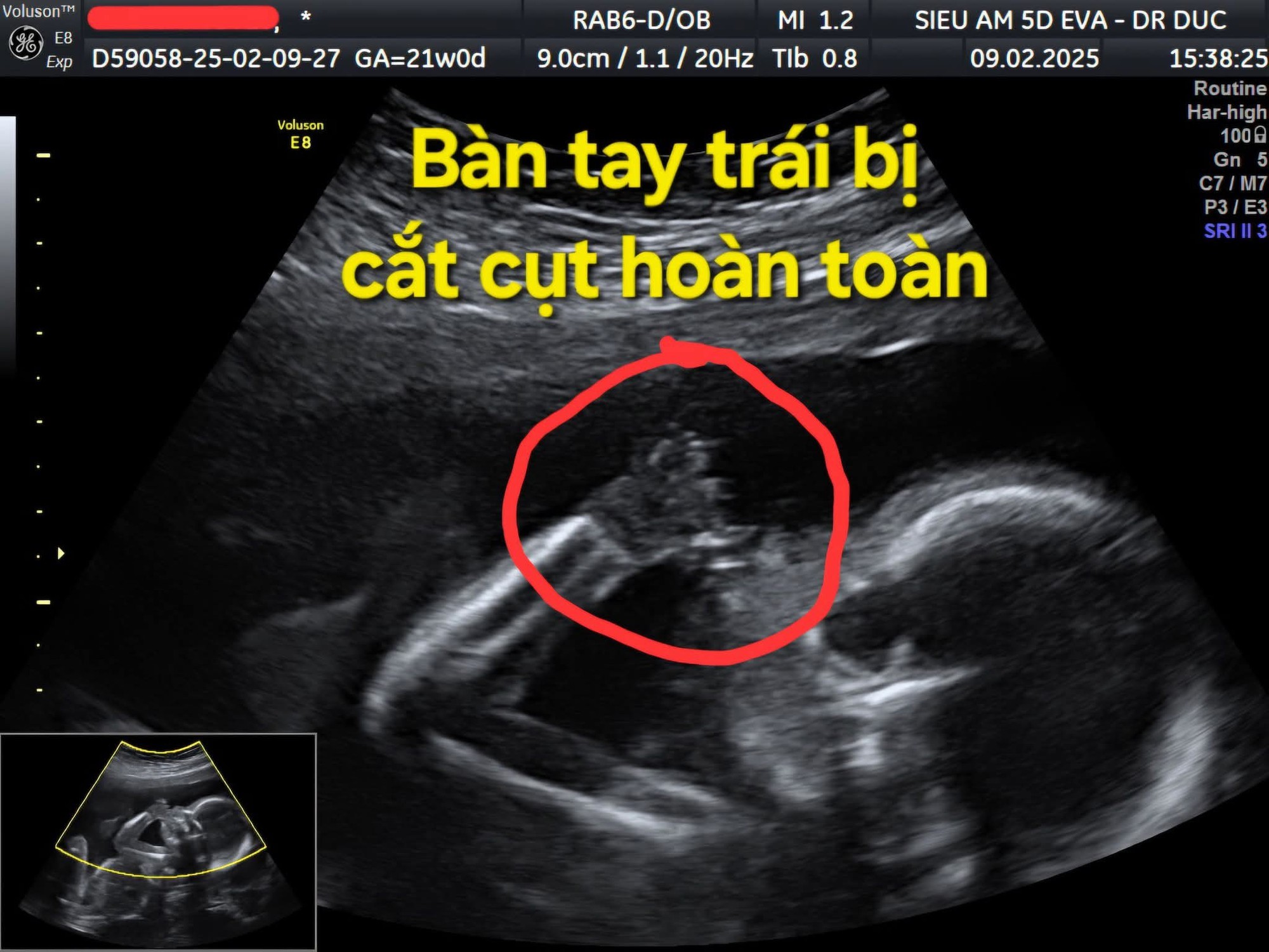Thai nhi 21 tuần bị cắt cụt các ngón tay vì một thứ 