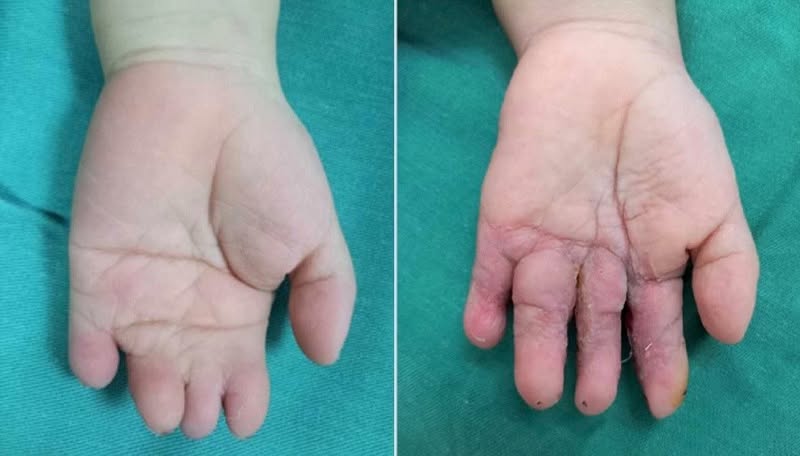 Thai nhi 21 tuần bị cắt cụt các ngón tay vì một thứ 