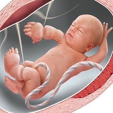 Thai nhi 21 tuần bị cắt cụt các ngón tay vì một thứ 