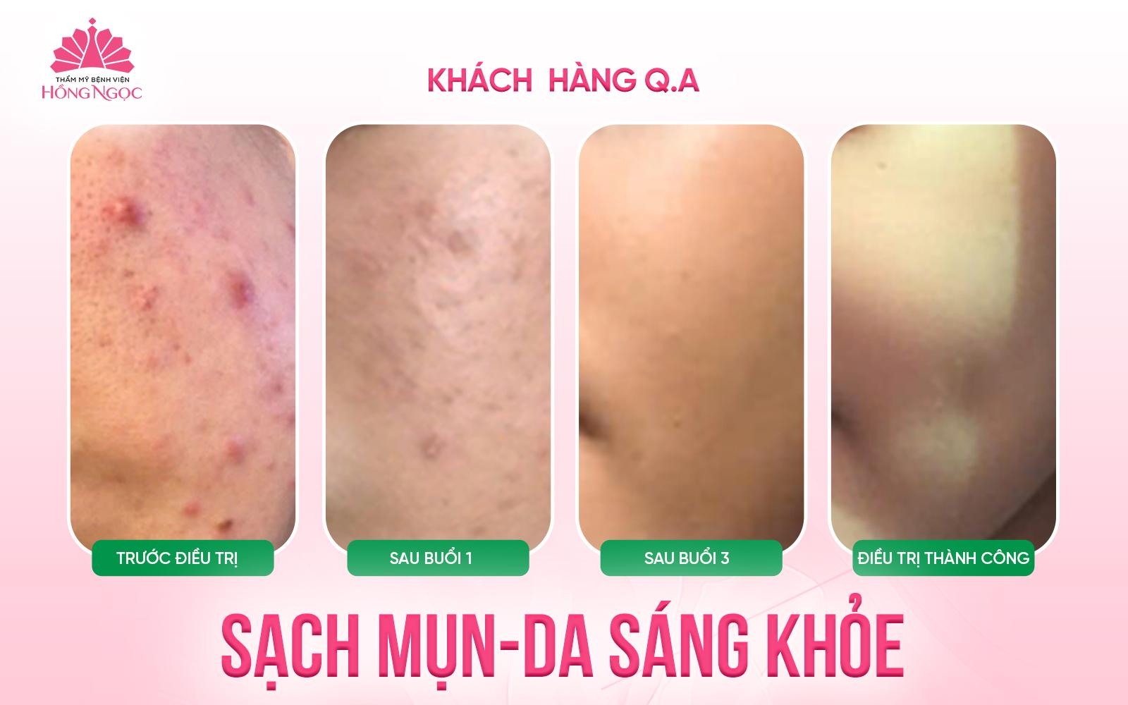 Làn da tuổi dậy thì - Chú ý đừng để quảng cáo "đẹp rẻ" dẫn lối sai cách- Ảnh 1.