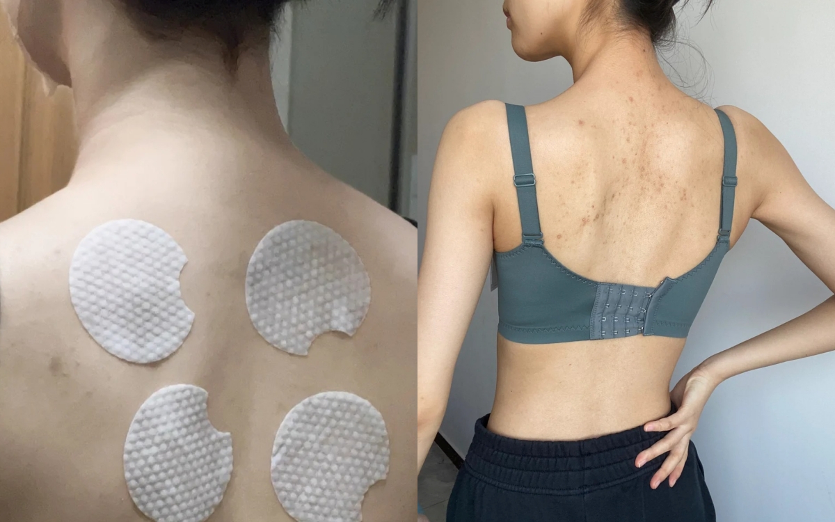 Từ mụn sần sùi, lưng tôi đã "nhẵn nhụi" hoàn toàn nhờ món đồ rẻ tiền này!- Ảnh 1.