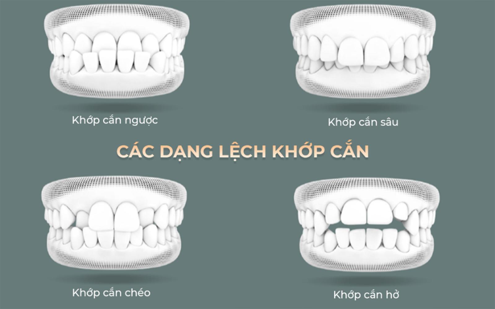 Niềng chuẩn không chỉ để đẹp mà để Gen Z cười chill đúng chất- Ảnh 1.