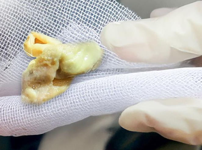Chảy mũi có mùi hôi sau 5 ngày nâng mũi, người phụ nữ tá hỏa phát hiện 
