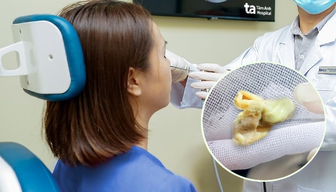 Thở thấy mùi hôi, người phụ nữ 31 tuổi ở TP.HCM phát hiện bị thẩm mỹ viện bỏ quên một thứ trong mũi suốt 1 tháng- Ảnh 1.