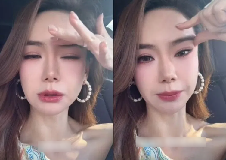 Nữ diễn viên nổi tiếng thừa nhận gương mặt "cứng đờ" vì tiêm botox quá liều, bác sĩ cảnh báo: 0,00000005 gram chất này có thể gây tử vong- Ảnh 1.