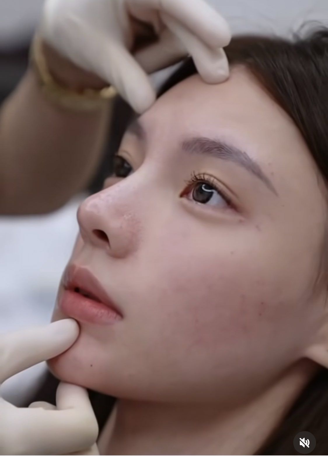 Những dấu hiệu bạn đang bị biến chứng sau khi làm mũi- Ảnh 2.