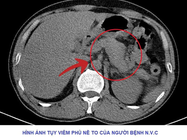 Uống nửa lít rượu mỗi ngày suốt 5 năm, người đàn ông bị viêm tụy cấp- Ảnh 2.