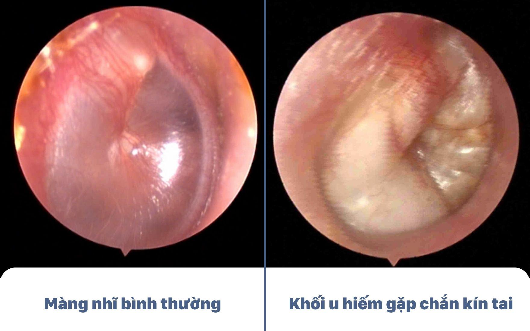 Tưởng viêm tai giữa ra là khối u Cholesteatoma chắn kín tai bé 3 tuổi- Ảnh 1.
