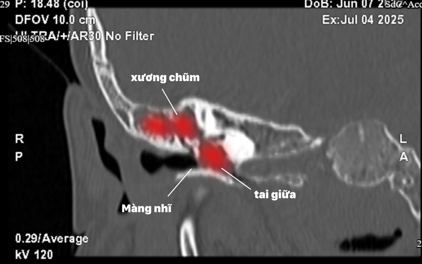 Tưởng viêm tai giữa ra là khối u Cholesteatoma chắn kín tai bé 3 tuổi- Ảnh 2.
