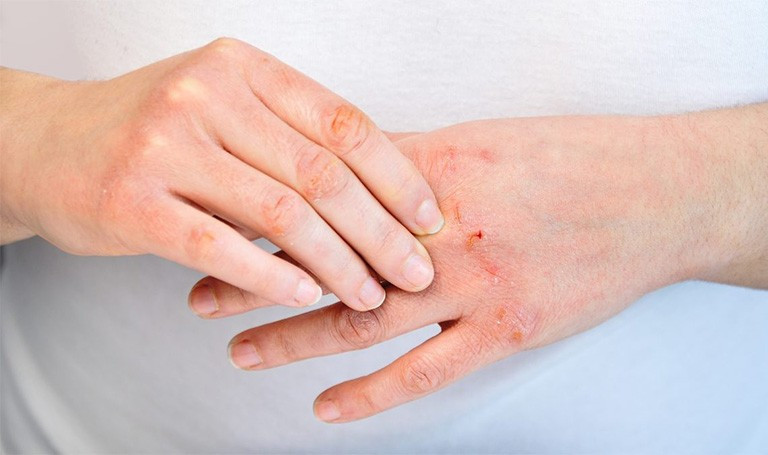 Mưa b&atilde;o, lụt lội: Cẩn trọng với nguy cơ bỏng v&agrave; mắc c&aacute;c bệnh về da- Ảnh 1.
