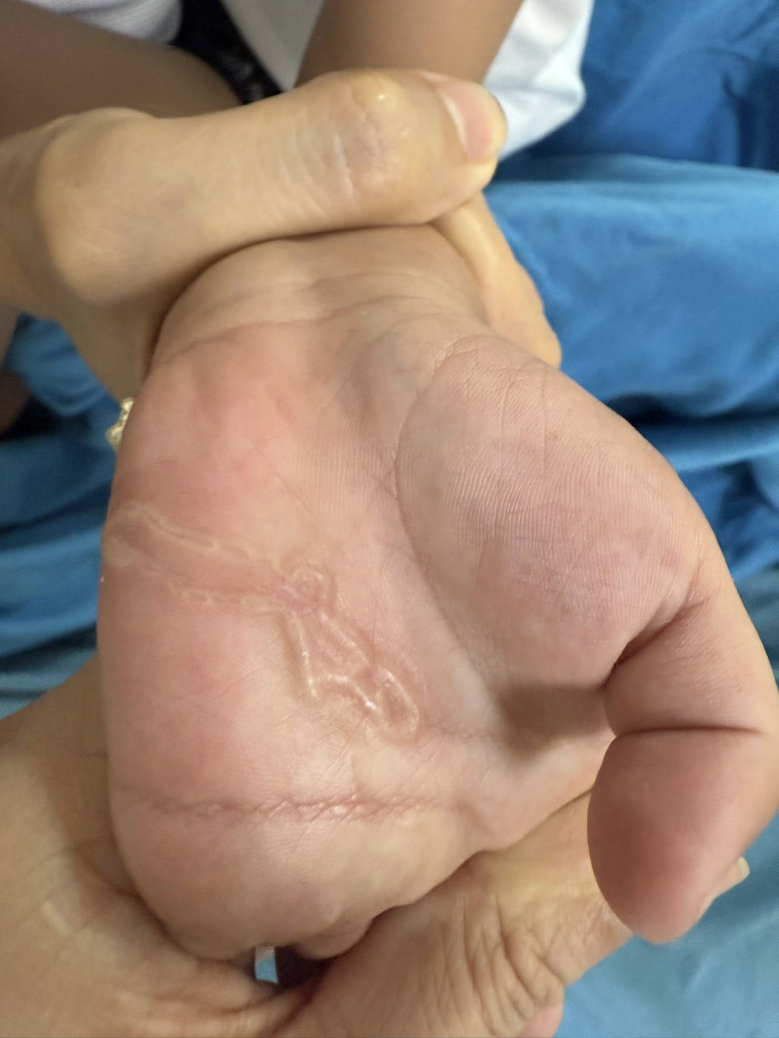 Bàn tay bé trai xuất hiện dấu hiệu lạ sau lần nghịch cát- Ảnh 1.