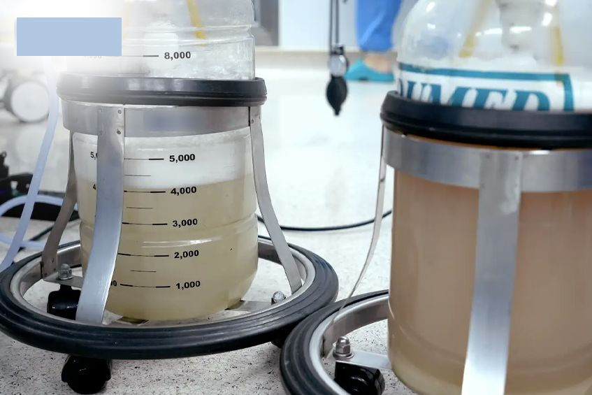 Hút ra gần 30 lít dịch đục "như bùn" từ phổi người đàn ông- Ảnh 1.