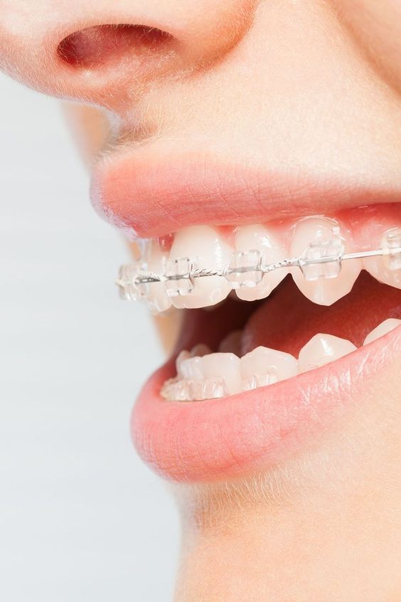 Niềng răng mắc cài kim loại vs mắc cài sứ: Ưu và nhược điểm cần biết trước khi lựa chọn- Ảnh 4.