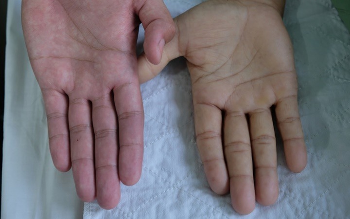 Một bệnh lý nguy hểm không chừa một ai: từ trẻ em, phụ nữ đến người làm văn phòng!- Ảnh 2.