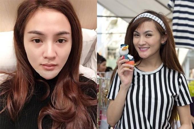 Mỹ nhân Việt khốn đốn vì phẫu thuật hỏng, suýt phải bỏ cằm do hoại tử- Ảnh 4.