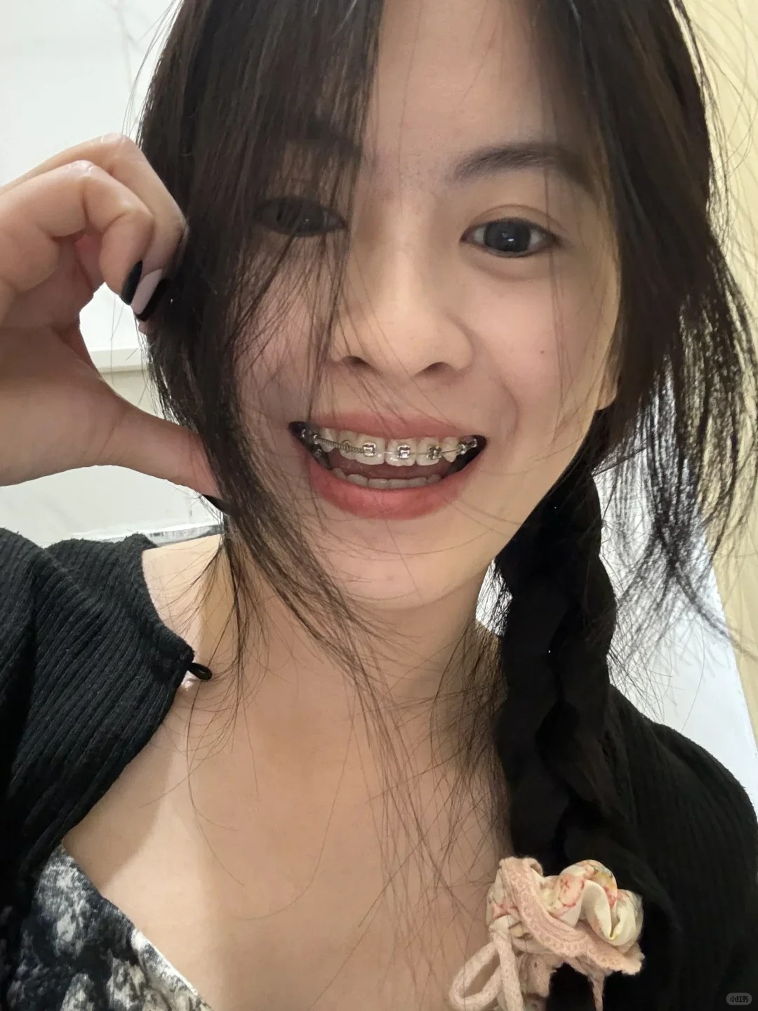 Chỉnh nha kiểu Meaw - Geaw: Vì sao được giới trẻ săn đón?- Ảnh 8.