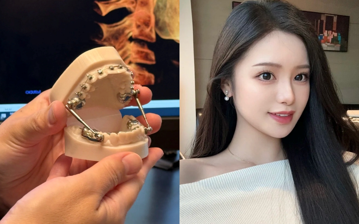Chỉnh nha kiểu Meaw - Geaw: Vì sao được giới trẻ săn đón?- Ảnh 1.