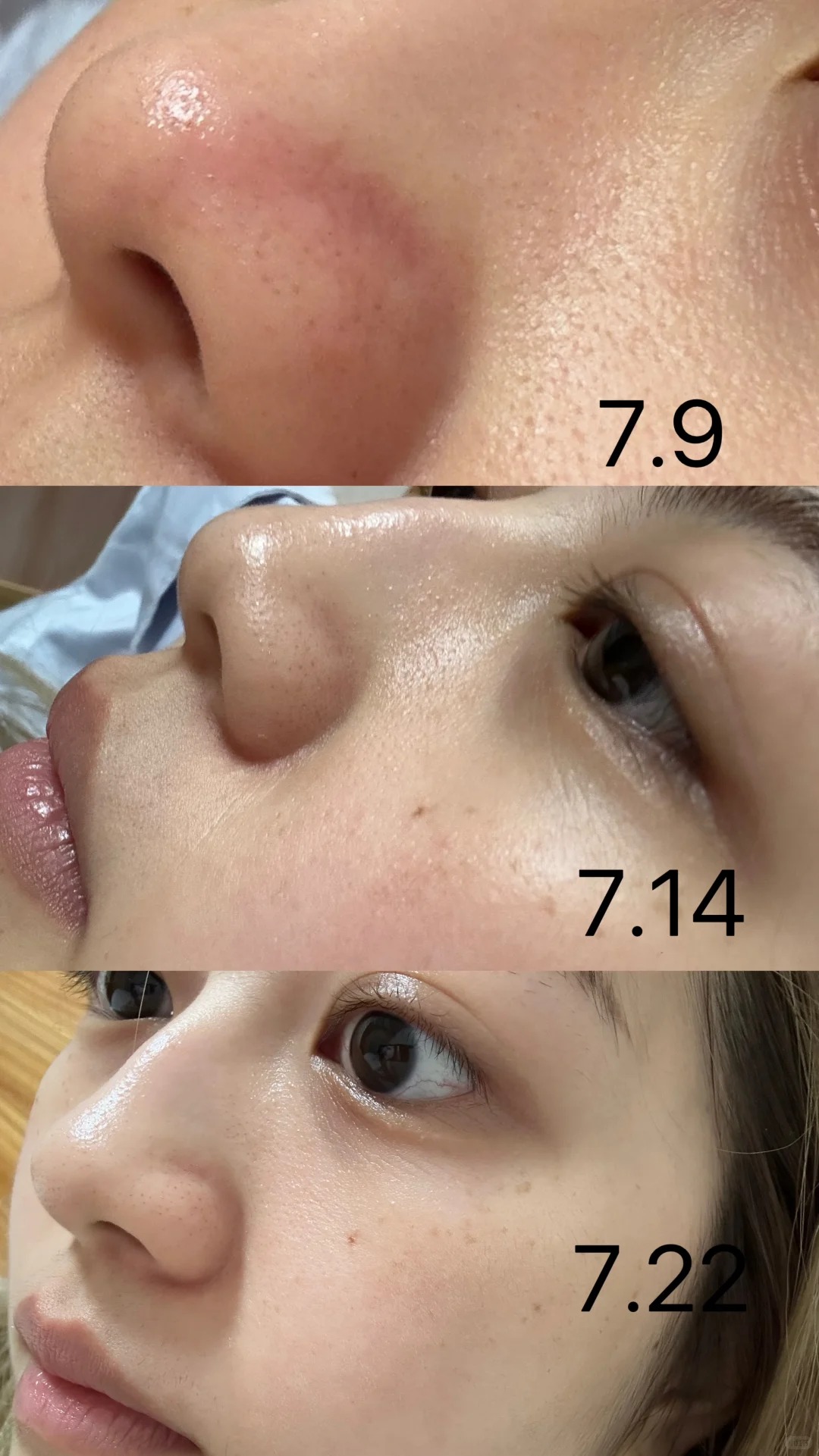 Lỗ chân lông nhỏ đi thấy rõ sau 1 tháng cô nàng này dùng bộ đôi serum dưỡng da bình dân của Hàn- Ảnh 6.