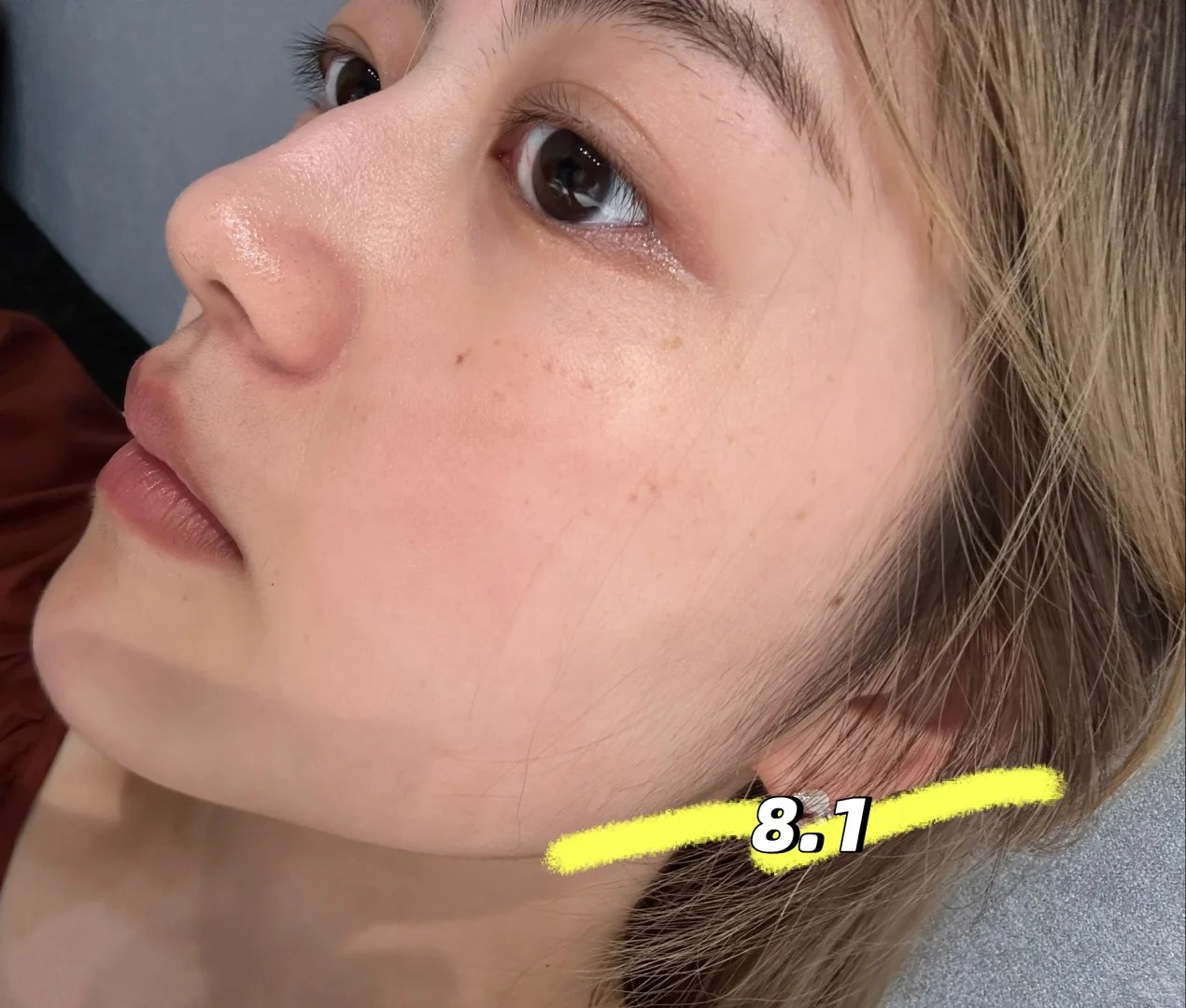 Lỗ chân lông nhỏ đi thấy rõ sau 1 tháng cô nàng này dùng bộ đôi serum dưỡng da bình dân của Hàn- Ảnh 3.