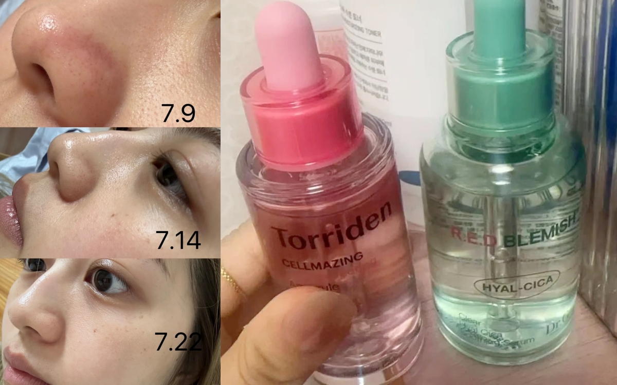 Lỗ chân lông nhỏ đi thấy rõ sau 1 tháng cô nàng này dùng bộ đôi serum dưỡng da bình dân của Hàn- Ảnh 2.