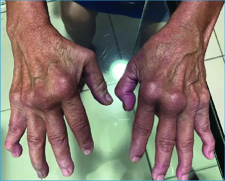 CDC Mỹ khuyến cáo cách phòng dịch Chikungunya đang bùng phát ở Trung Quốc, gần 3.000 ca mới trong một tuần- Ảnh 2.