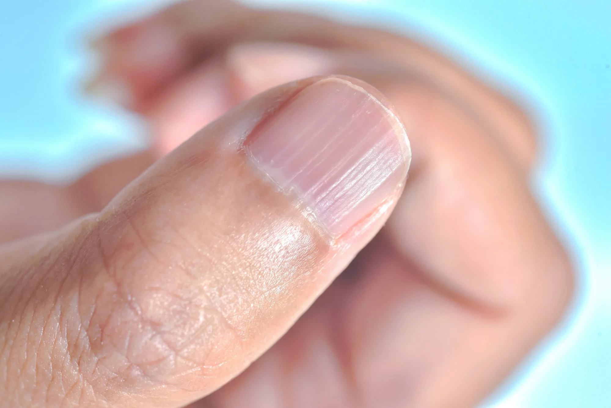 Người thiếu sắt nhìn vào móng tay thấy ngay 3 điểm, hãy mau tự kiểm tra- Ảnh 1.