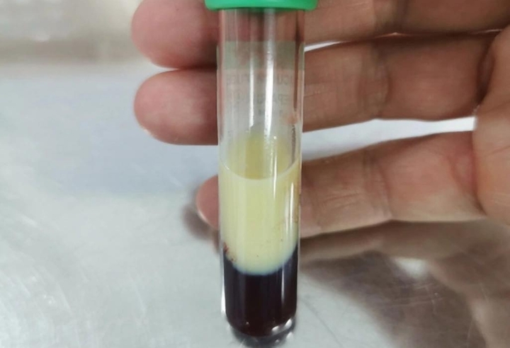 'Nhấp' vài lon bia mỗi tối, thanh niên suýt mất mạng vì mỡ máu tăng vọt- Ảnh 1. 'Nhấp' vài lon bia mỗi tối, thanh niên suýt mất mạng vì mỡ máu tăng vọt- Ảnh 1.
