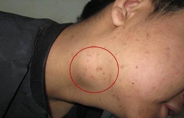 Loại ung thư có thể xuất hiện ở bất cứ vị trí nào trên cơ thể, không để ý 5 dấu hiệu này dễ "hối không kịp"- Ảnh 1. Loại ung thư có thể xuất hiện ở bất cứ vị trí nào trên cơ thể, không để ý 5 dấu hiệu này dễ "hối không kịp"- Ảnh 1.