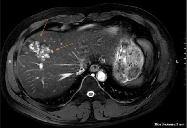 Người đàn ông 41 tuổi gan đầy ổ sán lá gan vì thói quen này của nhiều người Việt