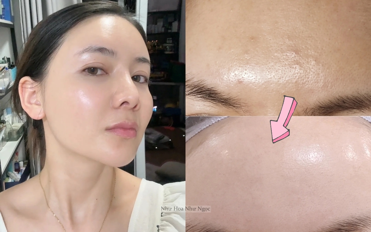 Thạc sĩ 36 tuổi chia sẻ hành trình trị mụn ẩn khoa học: Da sần sùi hóa láng mịn chỉ nhờ hiểu đúng- Ảnh 1.