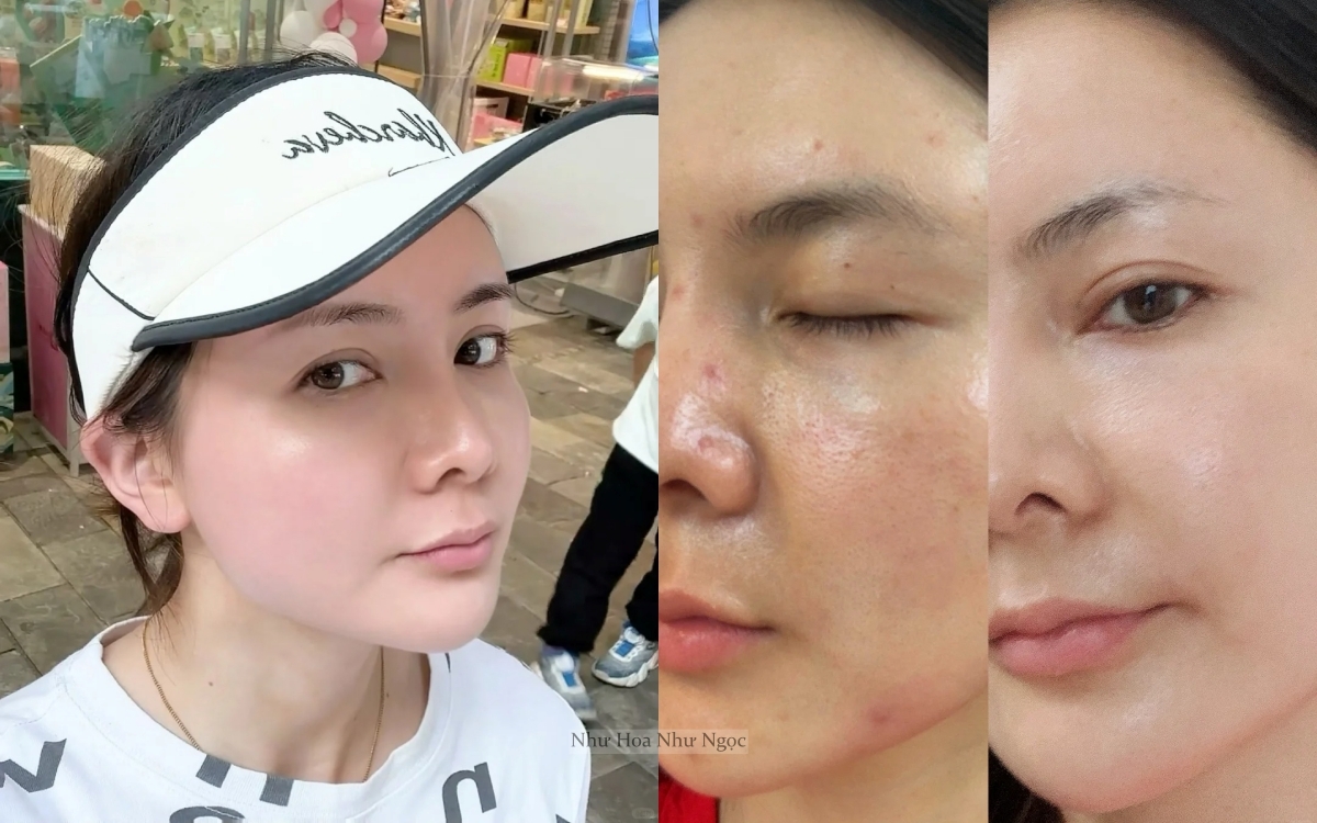 Thạc sĩ 36 tuổi chia sẻ hành trình trị mụn ẩn khoa học: Da sần sùi hóa láng mịn chỉ nhờ hiểu đúng- Ảnh 2.