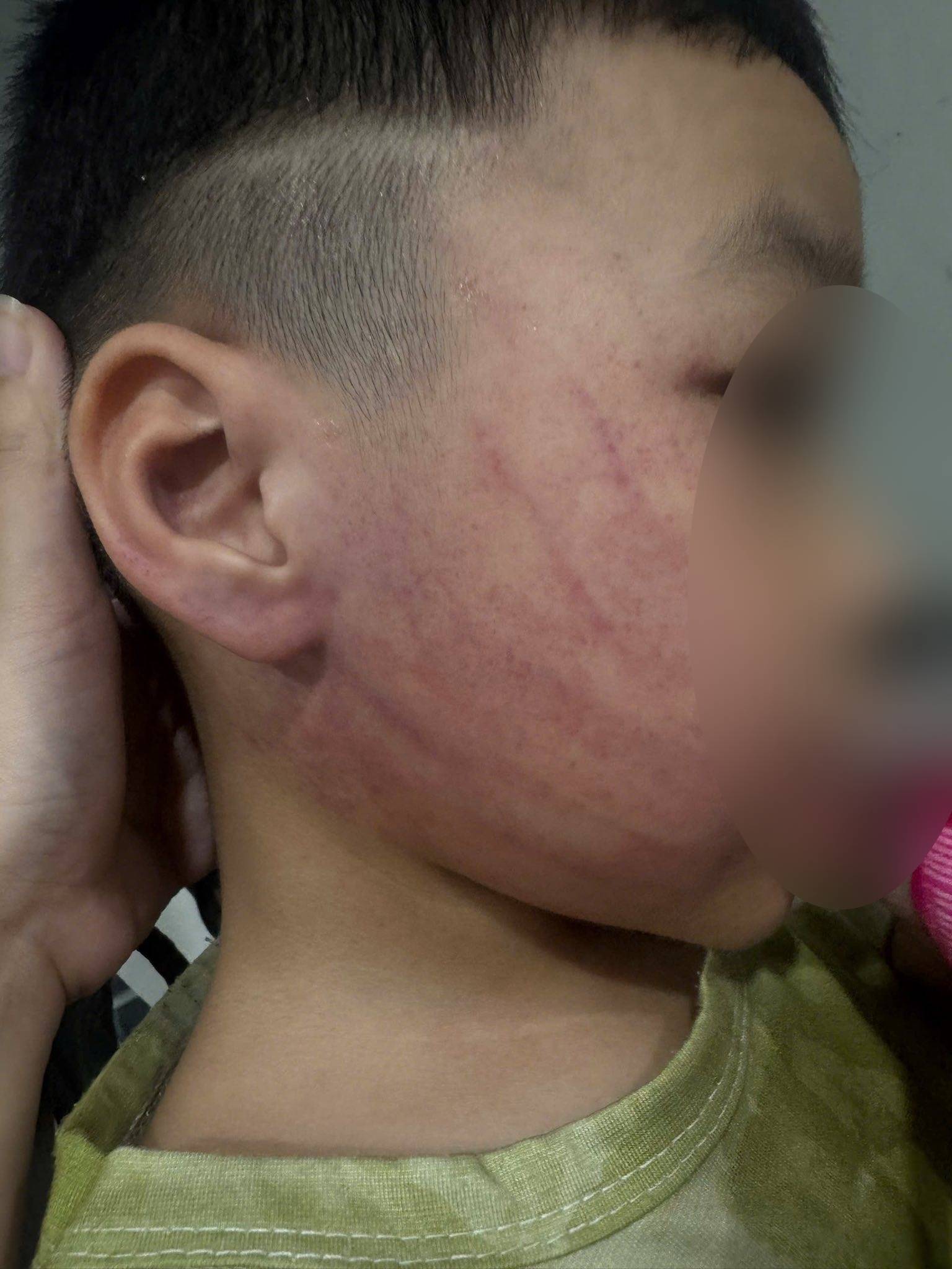 Xôn xao hình ảnh bé trai ở Hà Nội bị đánh tím mặt, phụ huynh phẫn nộ tố đích danh giáo viên- Ảnh 2.