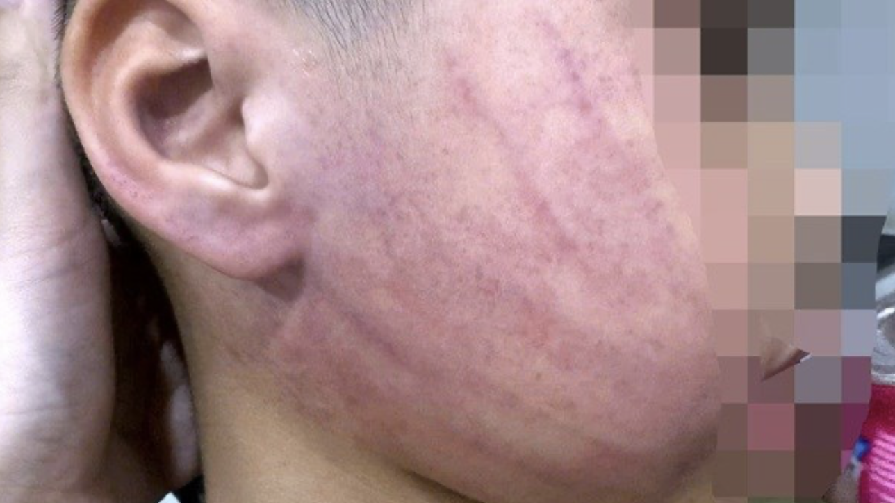 Điều tra vụ bé 4 tuổi nghi bị giáo viên mầm non đánh bầm tím mặt- Ảnh 1.